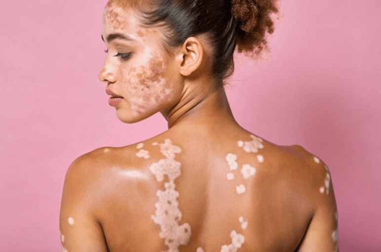 vitiligo-treatment
