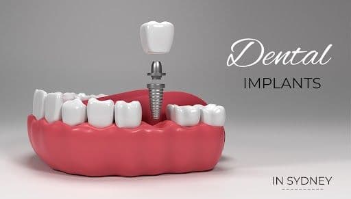 Dental Implant Cost Sydney